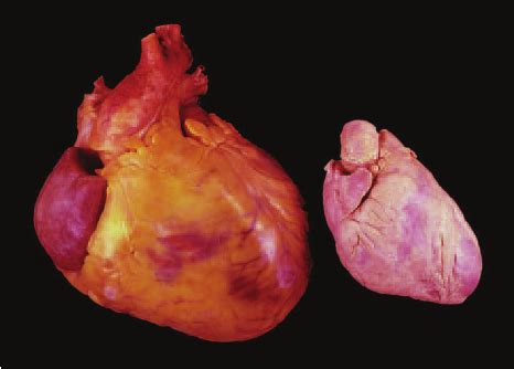 severe cardiomegaly with dilatation